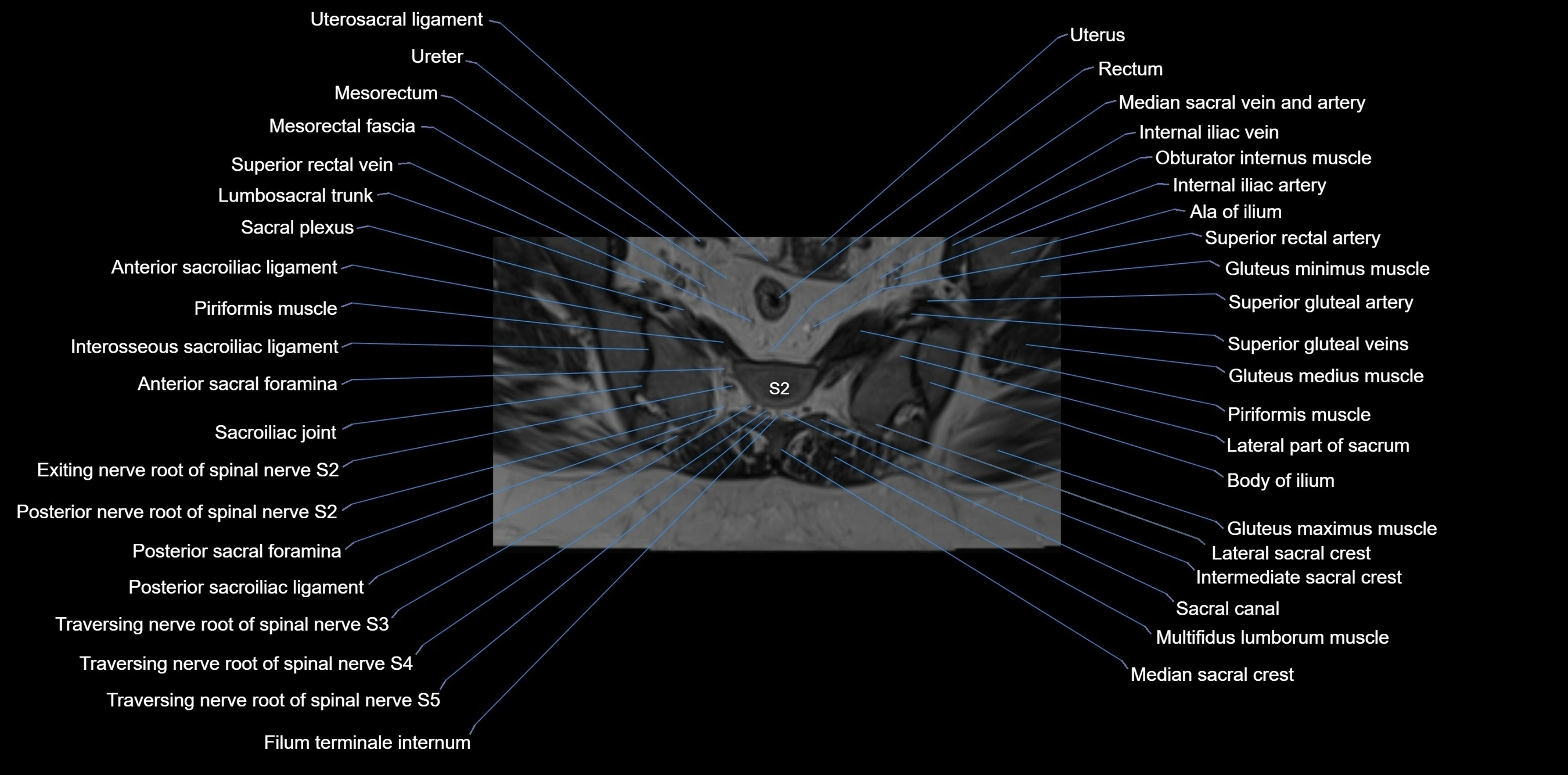 MRI sacrum, coccyx and sacroiliac joint axial cross sectional anatomy 3T  radiology  image-img-00001-00032.webp
